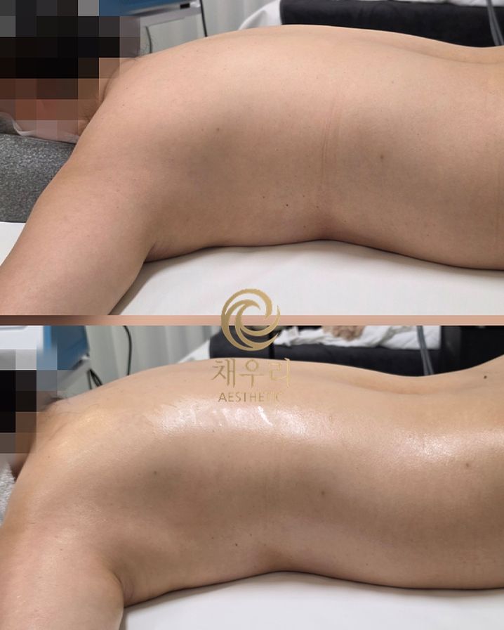 불광역 바디 — 채우리 에스테틱 등 라인 관리 전후
