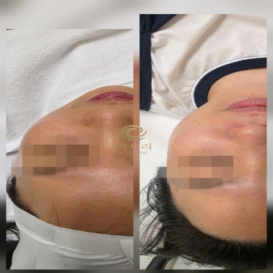 불광역 속건조·물광 — 채우리 에스테틱 라라필 관리 전후