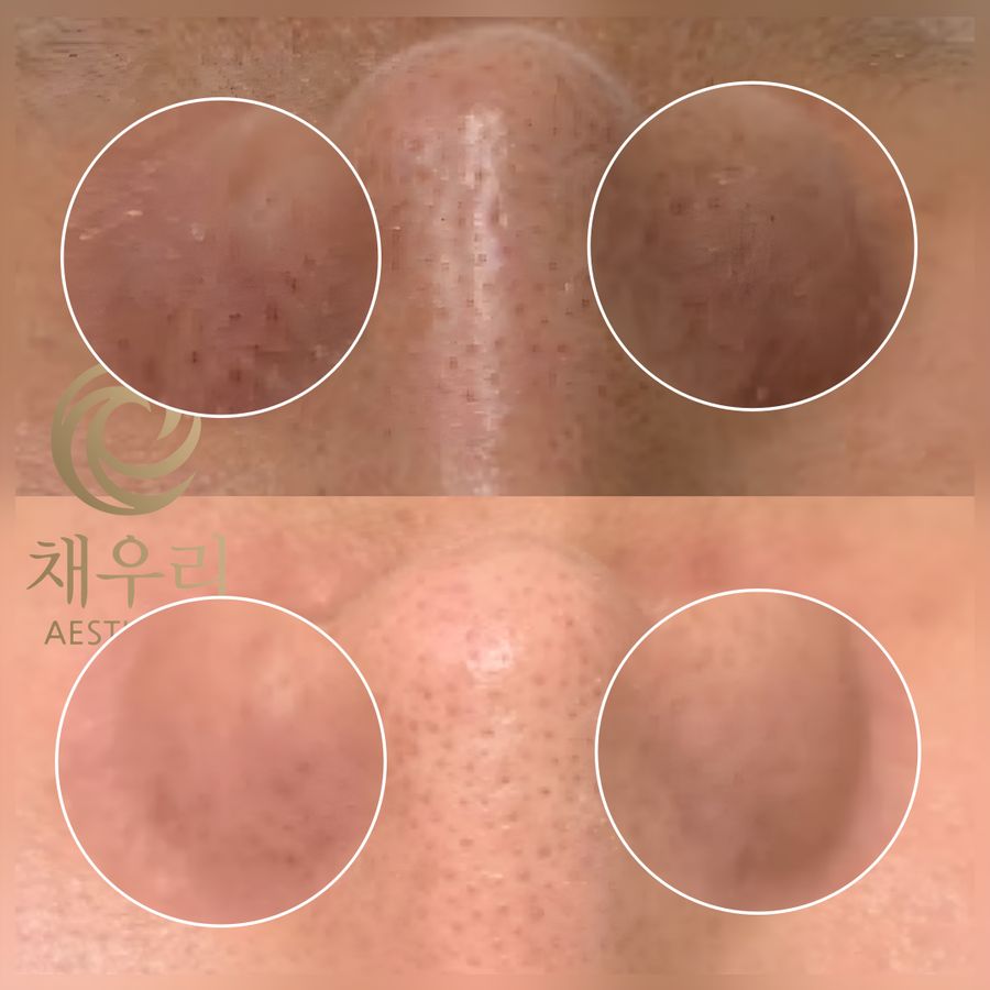 불광역 블랙헤드 — 채우리 에스테틱 코 모공 관리 전후