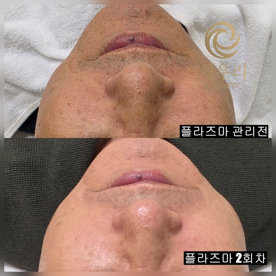 마포구 미백·기미 — 채우리 에스테틱 플라즈마 관리 전과 2회차