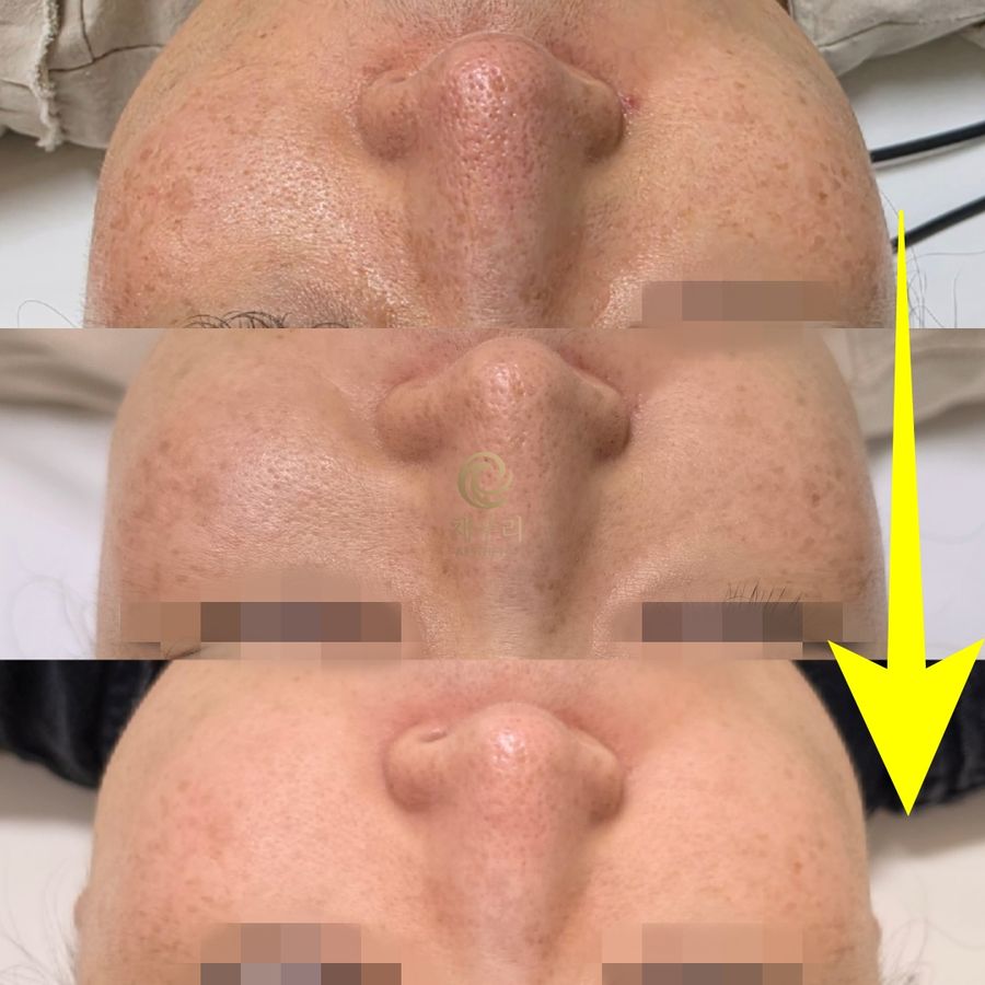 마포구 미백·기미 — 채우리 에스테틱 회차별 피부 변화