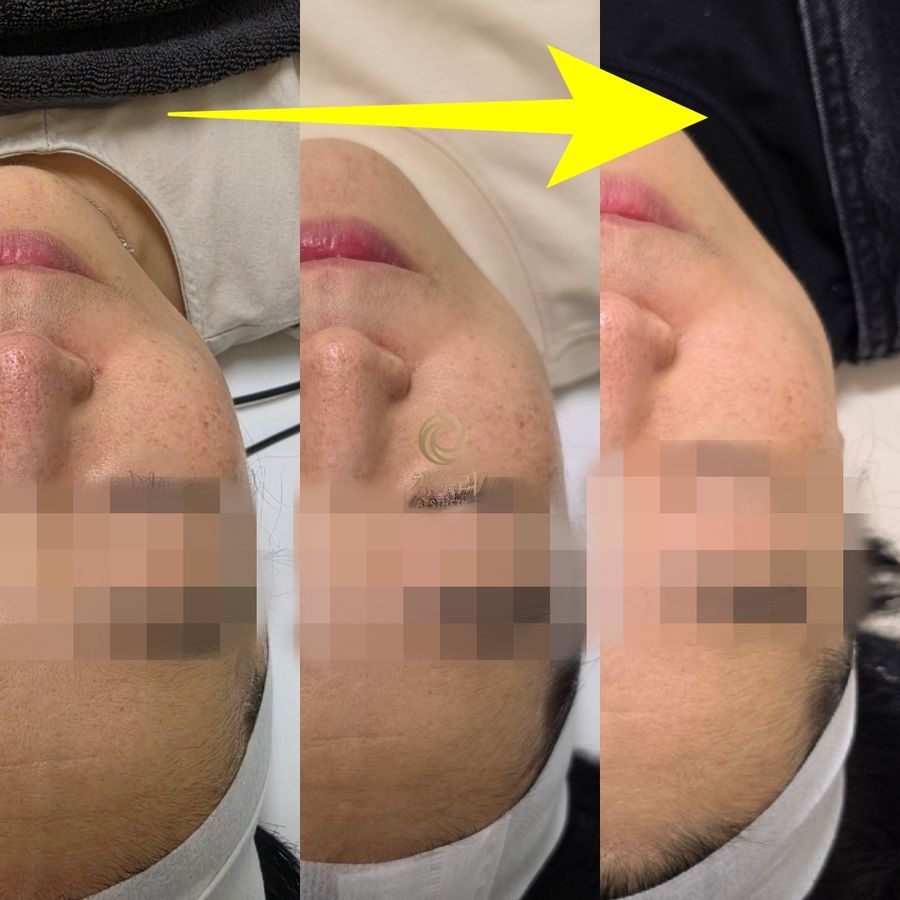 대조동 미백·기미 — 채우리 에스테틱 회차별 피부 변화