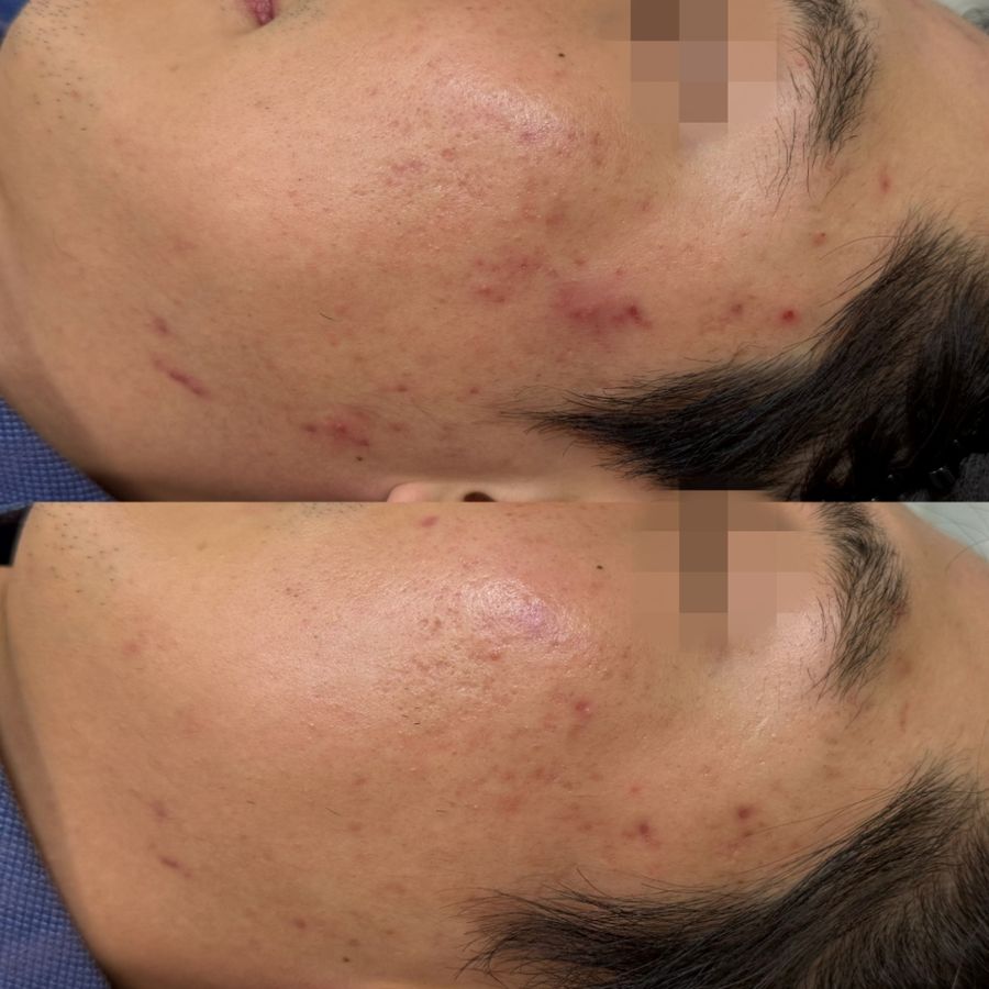 불광역 면포성 — 채우리 에스테틱 트러블 관리 전후
