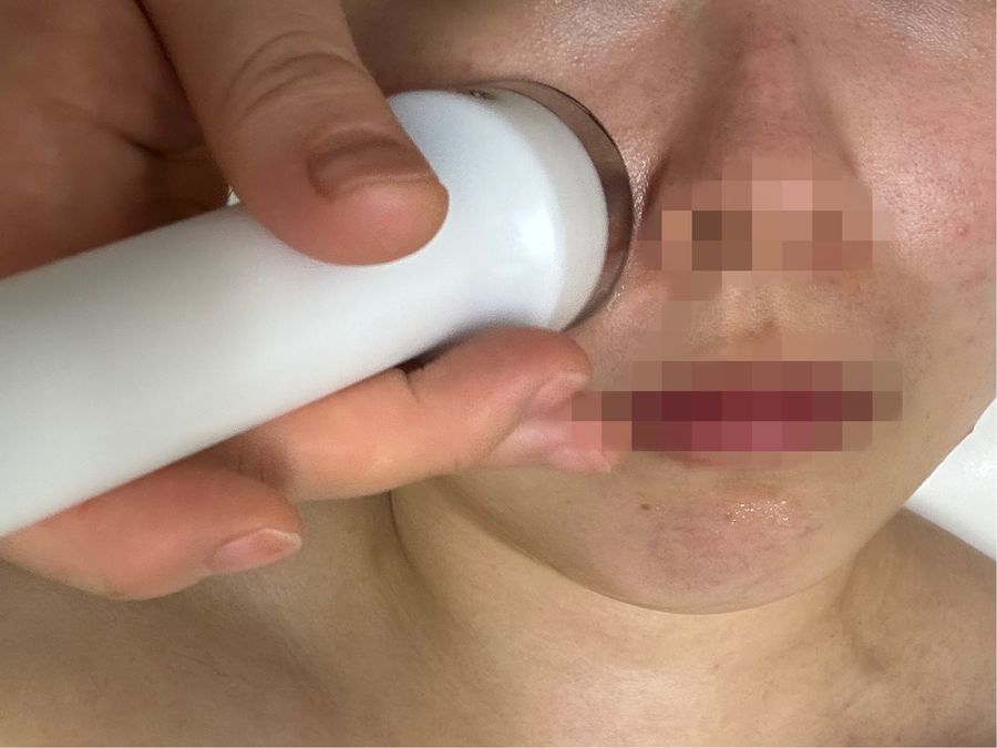 불광역 코 — 채우리 에스테틱 크라이오 기기로 피부 열감을 식혀요