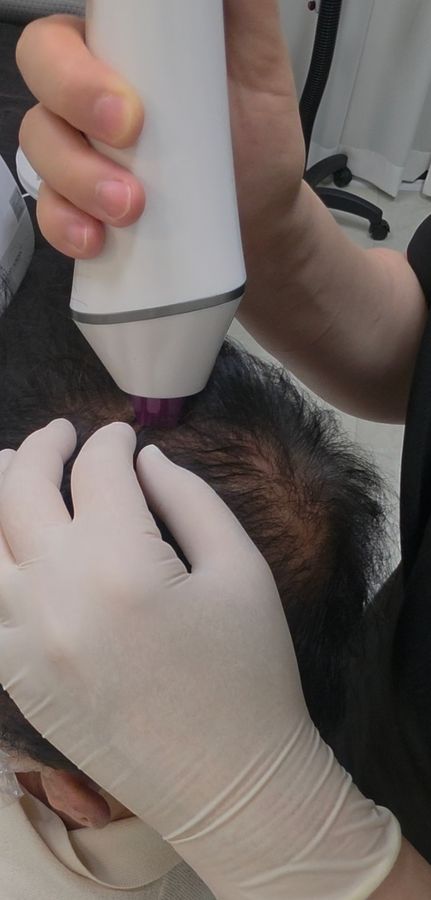 불광역 두피 — 채우리 에스테틱 울트라플라즈마로 두피를 정돈해요