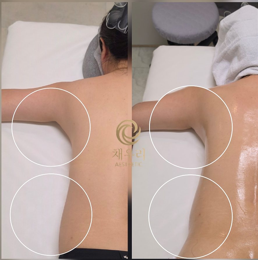독바위역 고주파 에너지테라피 바디관리 무겁게 짓누르는 어깨와 만성 부종, 생체 미세전류로 림프순환 — 채우리 에스테틱 불광점