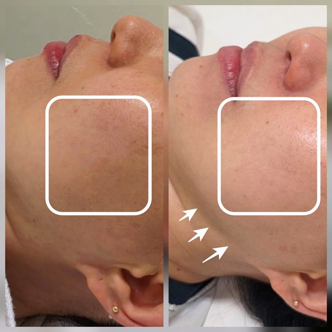 불광역 림프순환 관리 아침마다 붓는 얼굴과 칙칙한 안색, 목·어깨 데콜테부터 풀어야 맑아지는 이유 — 채우리 에스테틱 불광점