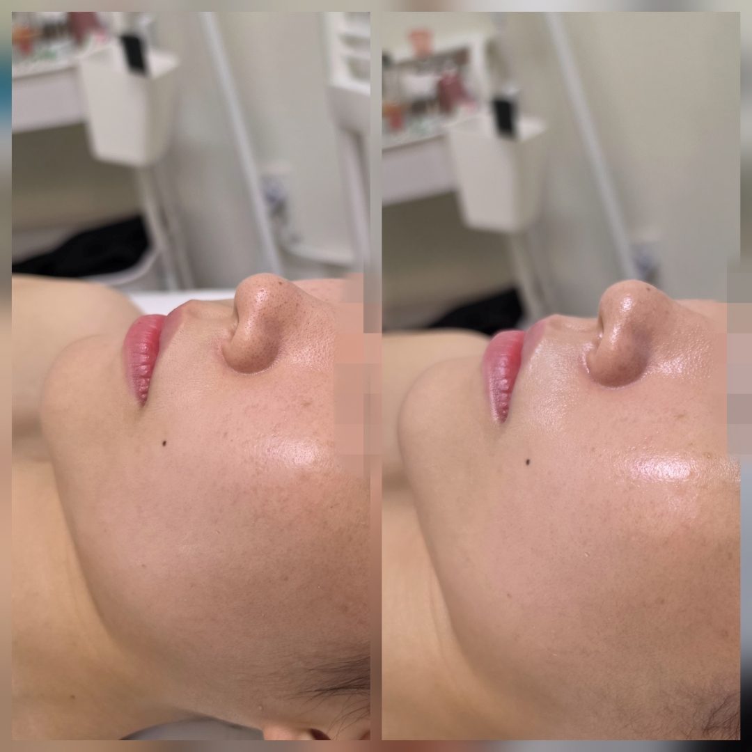 은평구 레이저 후 진정 케어 화끈거리는 열감과 쩍쩍 갈라지는 속건조를 잠재우는 애프터 진정법 — 채우리 에스테틱 불광점