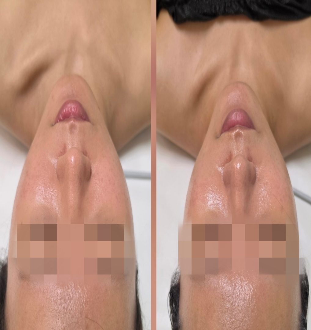 연신내 경락마사지 찾다가 오신 분께 — 작은얼굴 리프팅 과정을 순서대로 보여드릴게요 — 채우리 에스테틱 불광점