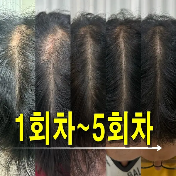 두피 — 가르마 두피 1~5회차