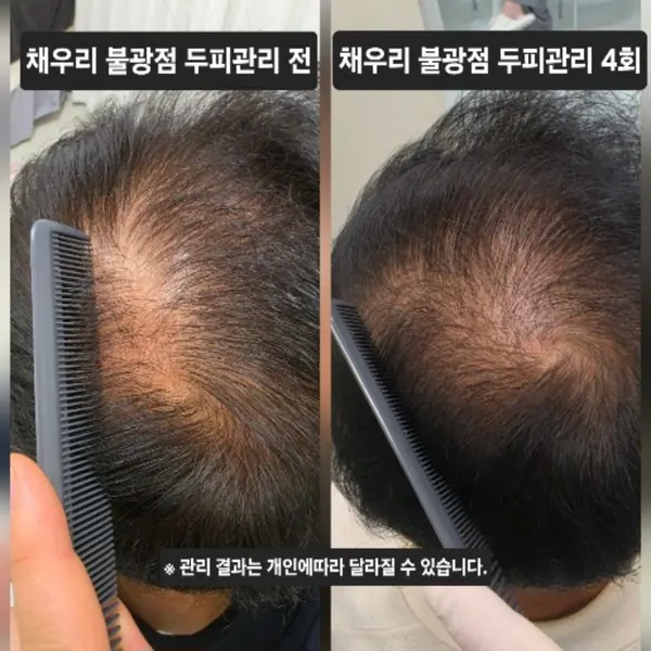 두피 — 두피 관리 4회