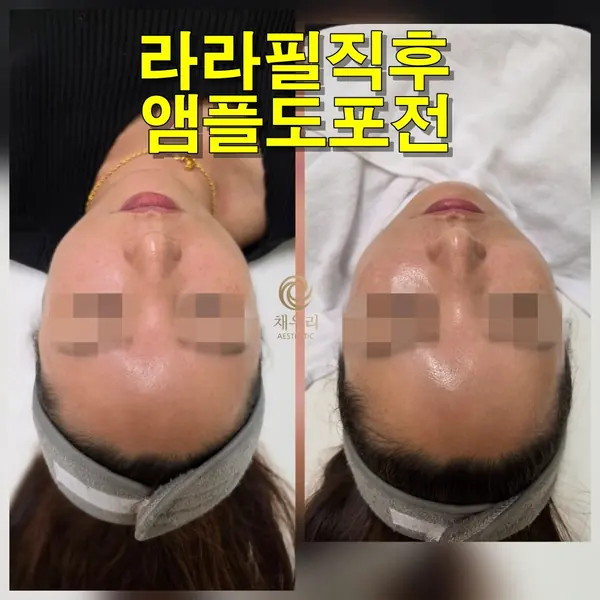 물광 — 라라필 직후 피부결