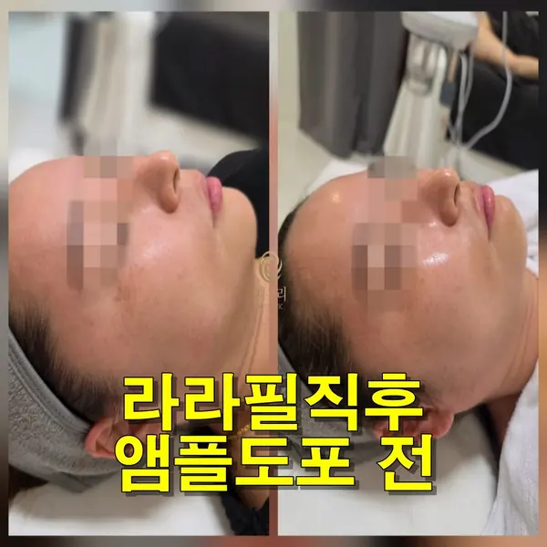 물광 — 라라필 직후 피부결